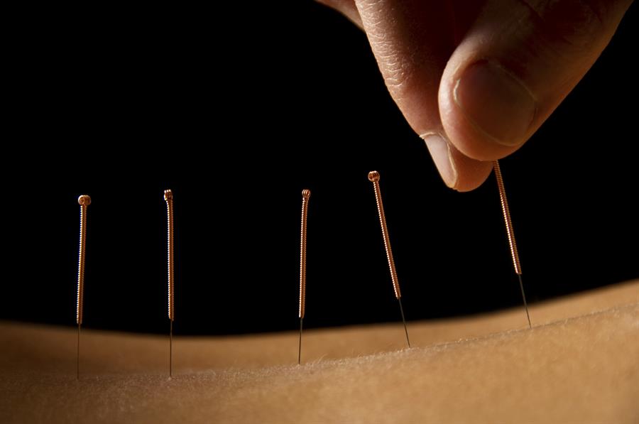 Close up of acupuncture needles being applied to skin.