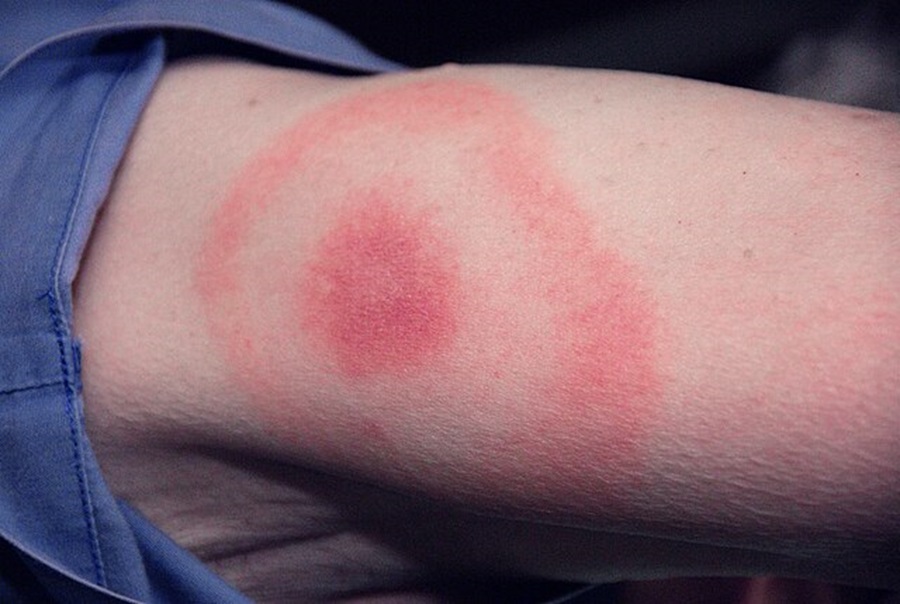 Lyne disease rash in the pattern of a “bull’s-eye”