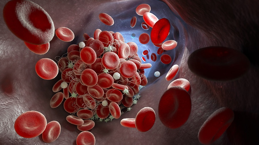 Blood vessel with red blood cells coagulating to form a blood clot as in deep vein thrombosis