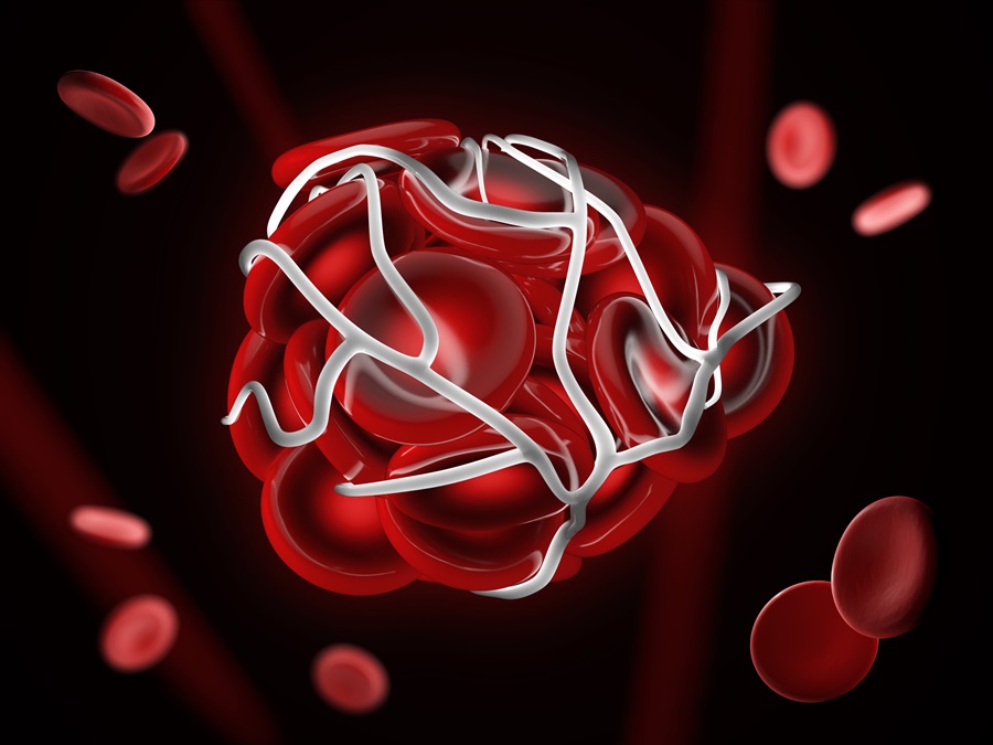 3D illustration of a blood clot or embolus