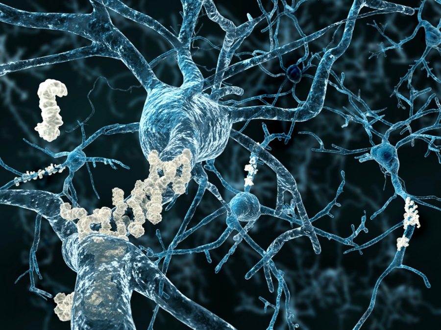 3-D Amyloid beta plaques on brain neurons in Alzheimer disease