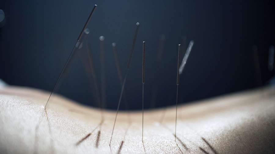 Acupuncture needles inserted in a person's back