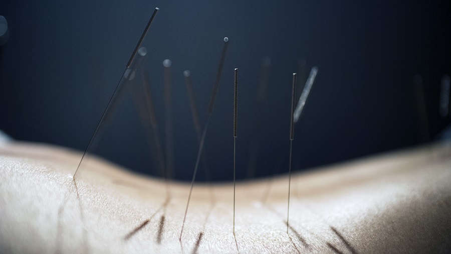 Acupuncture needles on a person's body